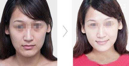 光子嫩肤美白效果好吗