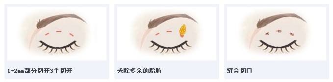 三点定位的双眼皮是怎么个做法?