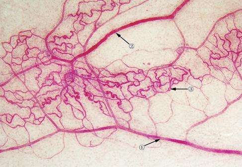 毛细血管瘤是什么