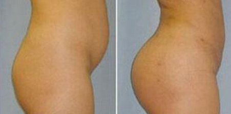自体脂肪丰臀能达到改善臀型的目的吗？