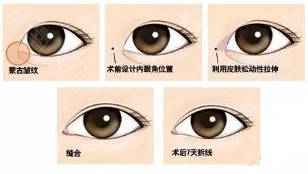 眼睛整容有哪几种？