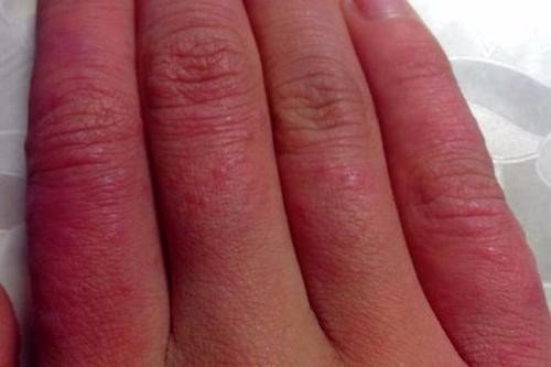 手上有冻疮发痒，要怎么办？