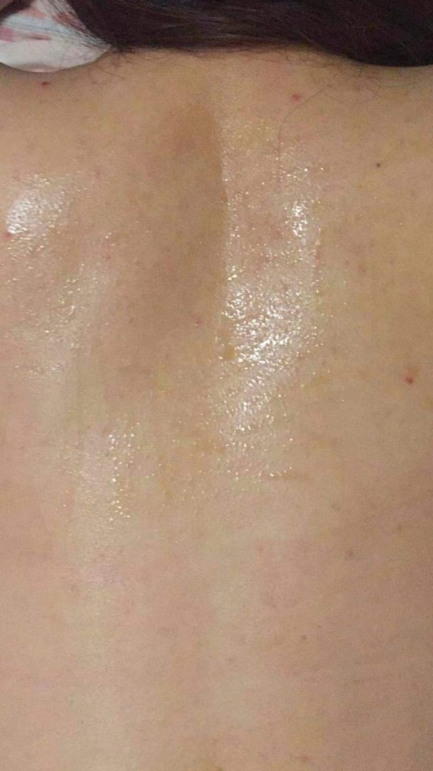 秋臣痘痘消好用么？请教一下！！！