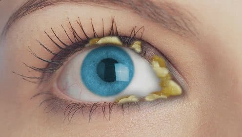 眼屎学名是什么