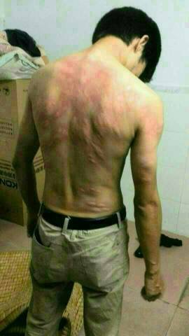 人被跳蚤咬了症状图片