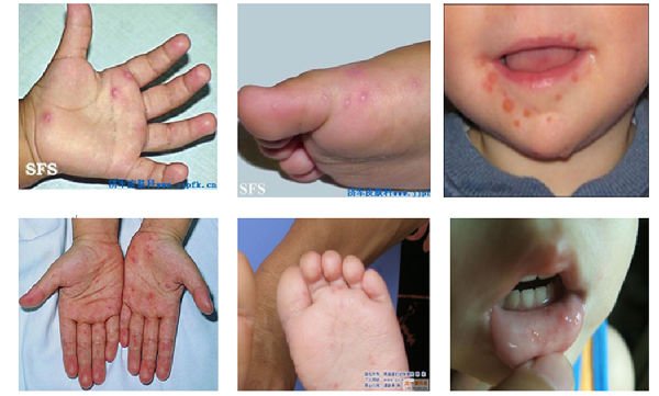 小儿手足口病症状图片是什么样的