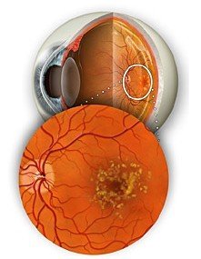 眼底黄斑变性如何治疗？