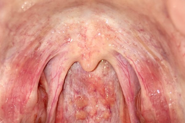 滤泡性咽炎能根治吗