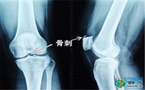 膝盖骨刺是怎么形成的？